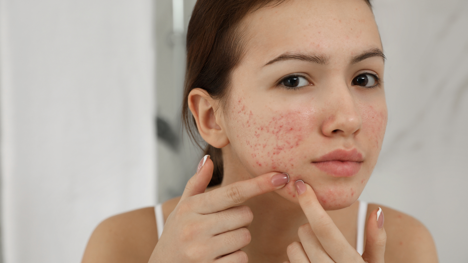 Best Chemical Peels For Acne Scars Rockville Dentist