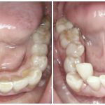 lower teeth invisalign rockville
