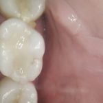 dental implant maryland