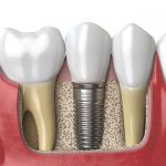 dental implants maryland
