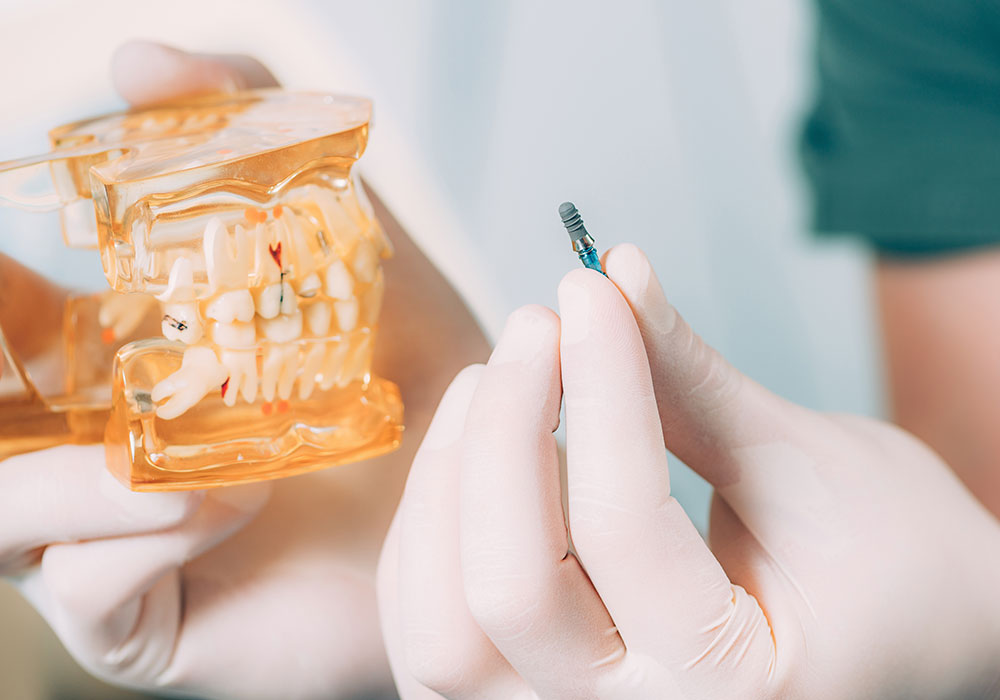 dental implants rockville
