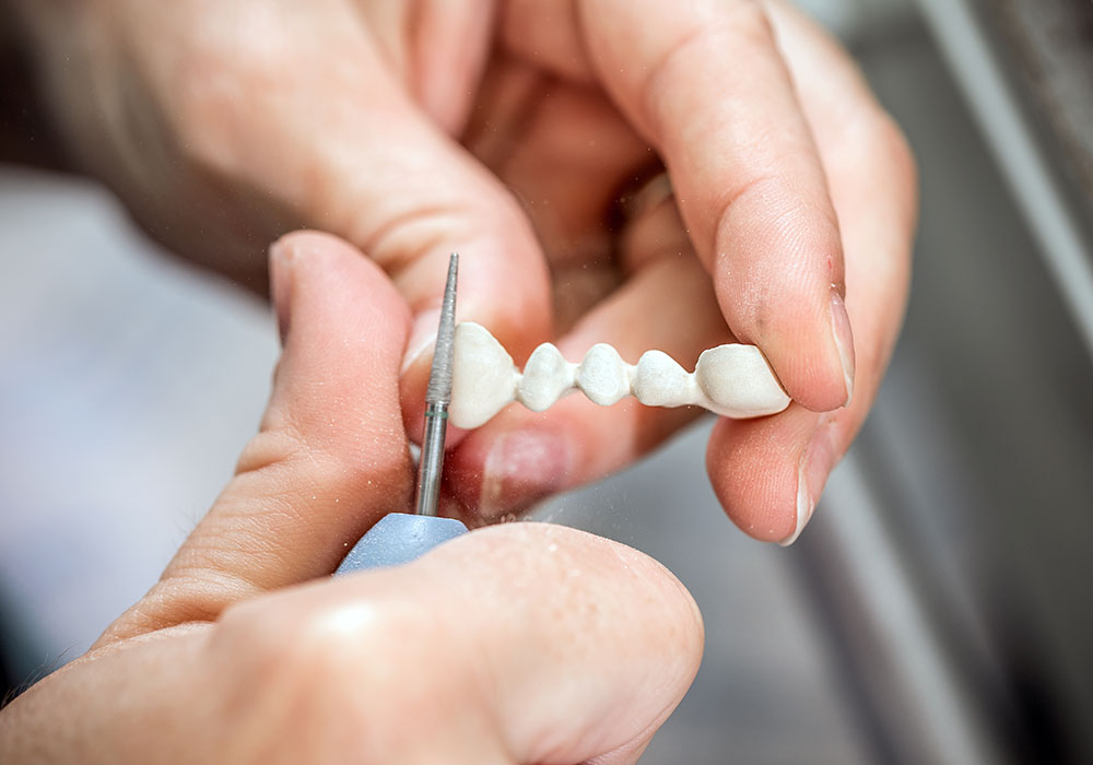 dental implants vs. bridges