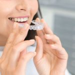 invisalign rockville