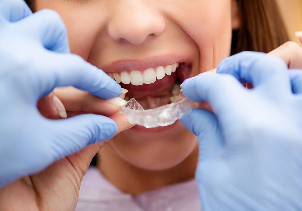 invisalign cost maryland