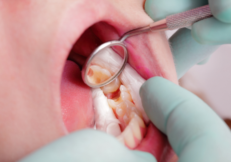 Cost of Dental Crowns in Maryland Best Crowns Rockville Hackley DDS