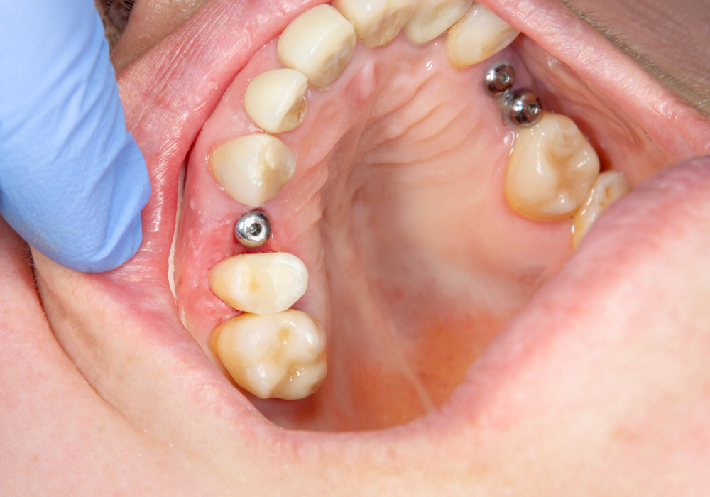 dental implants maryland