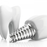 dental implants rockville