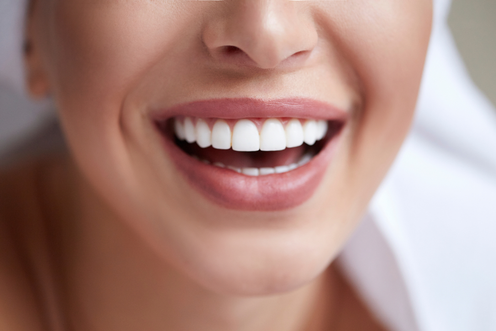 Are Veneers Covered by Dental Insurance?