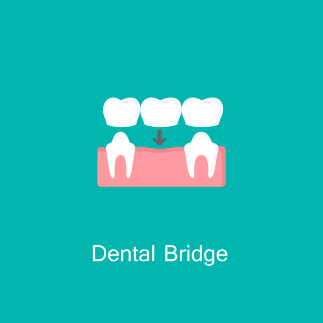 Dental Bridges in Rockville MD