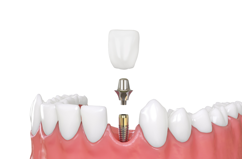 Dental Implant Costs in Germantown