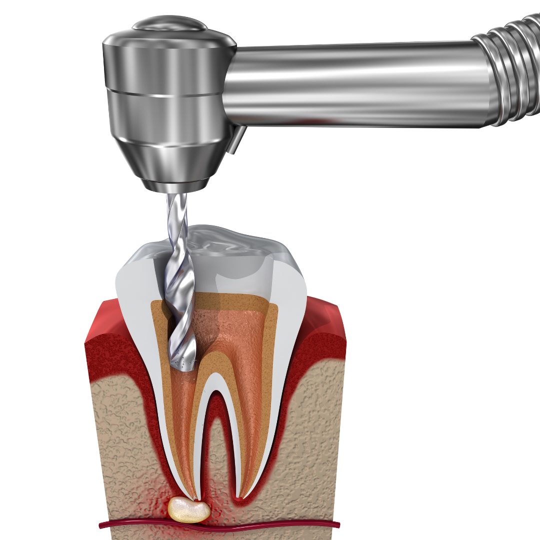 root canal specialist Rockville