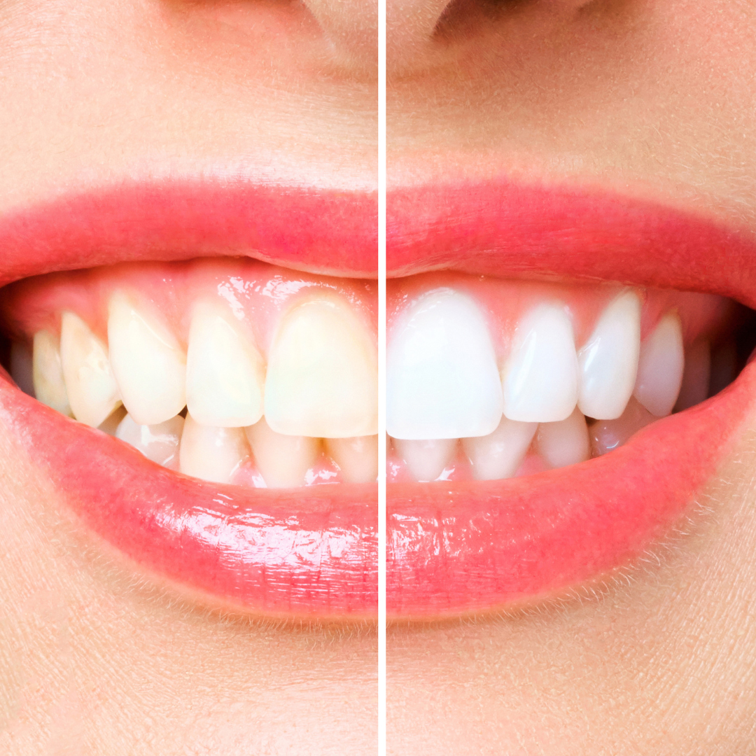 cost of teeth whitening rockville