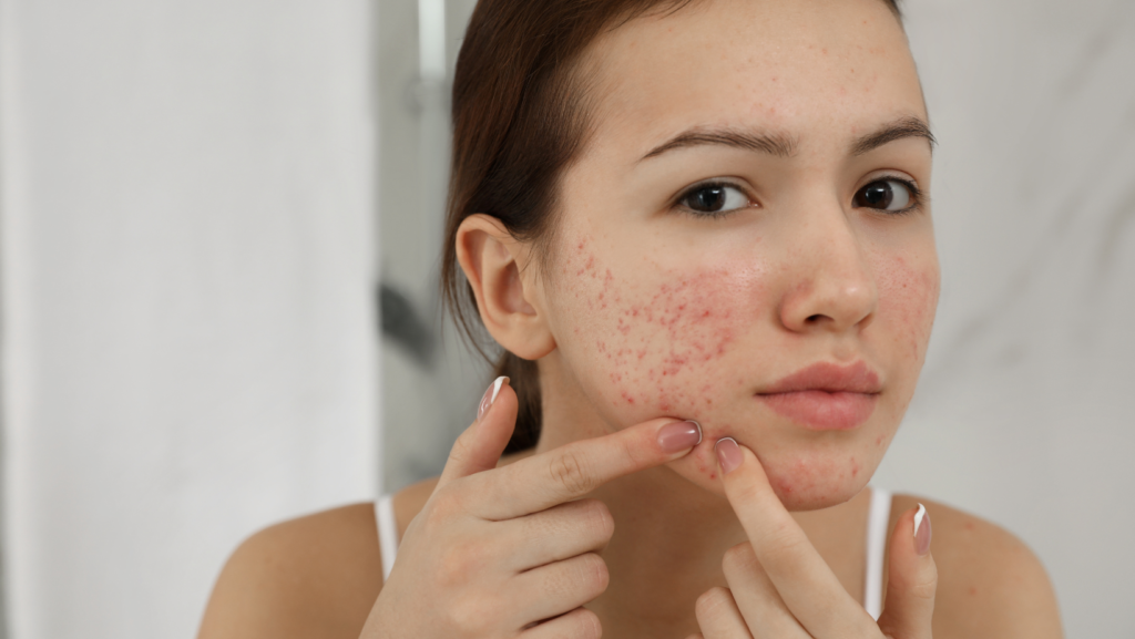 Chemical Peels for Acne Scars