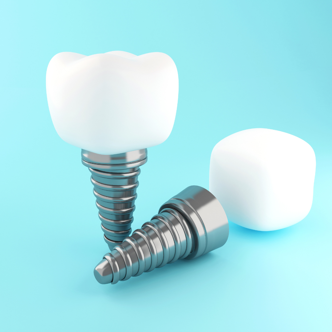 rockville dental implants