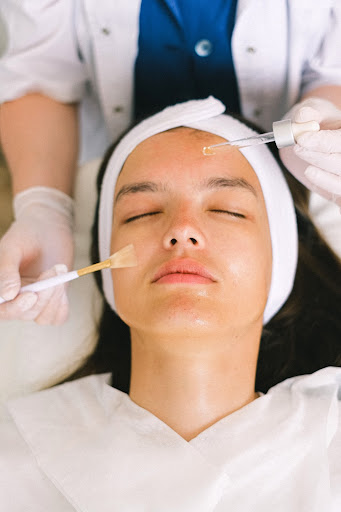 chemical peels for acne scars