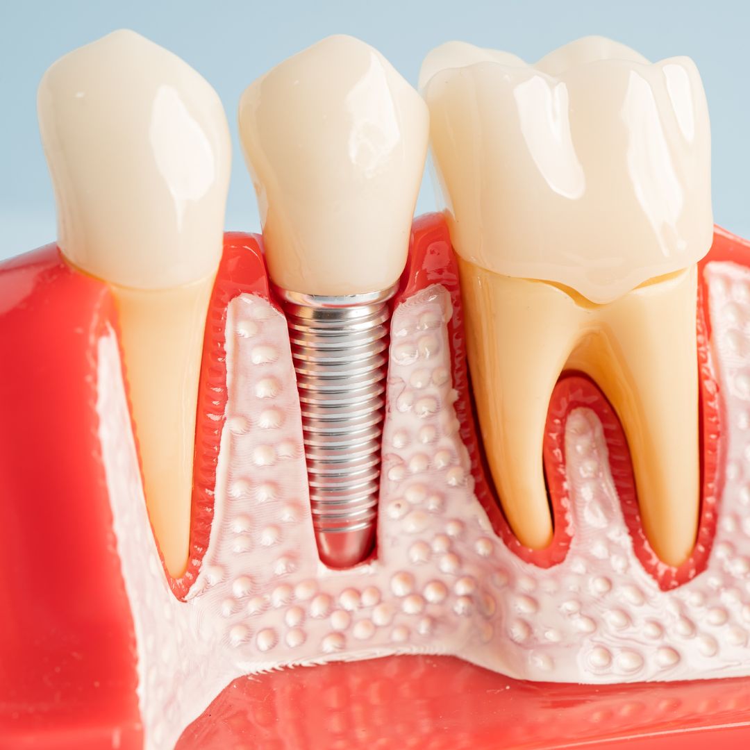 Tooth Implant Specialist in Rockville